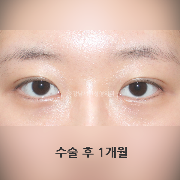 매몰쌍꺼풀+앞트임 AFTER