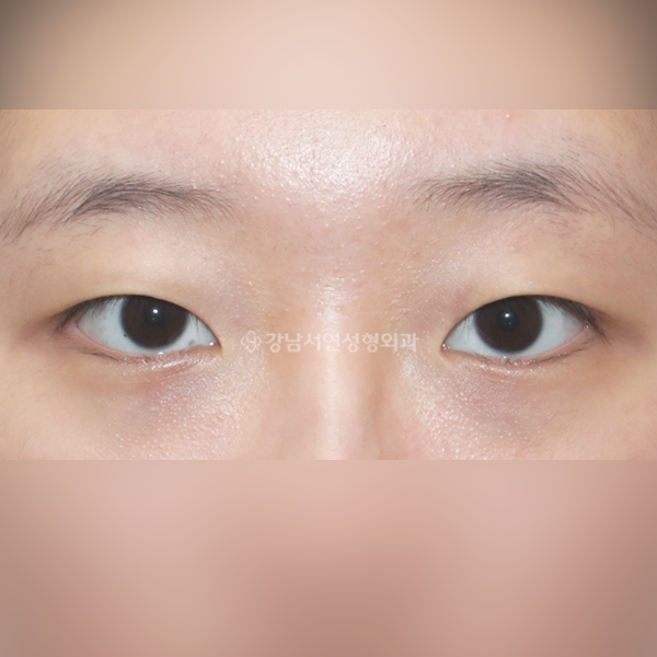 매몰쌍꺼풀+앞트임 BEFORE