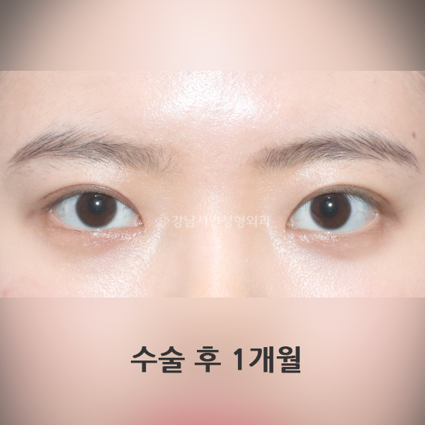 절개눈매교정+앞트임 AFTER