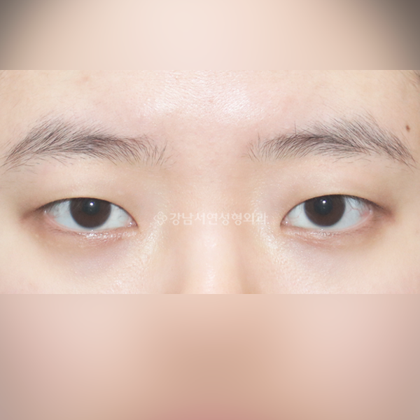 절개눈매교정+앞트임 BEFORE
