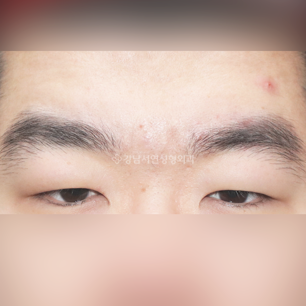 절개눈매교정 BEFORE