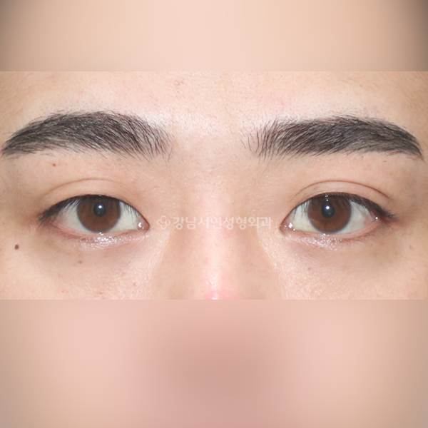 쌍꺼풀 없애기 BEFORE