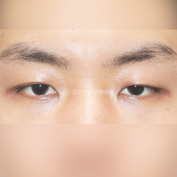 남자 무쌍눈매교정 BEFORE