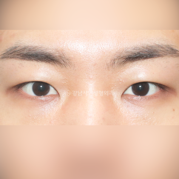 남자 무쌍눈매교정 AFTER