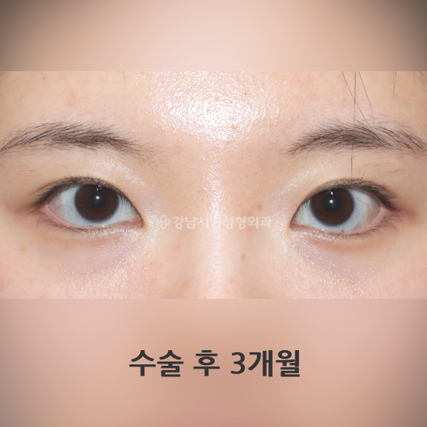 매몰쌍꺼풀+겹주름 교정 AFTER