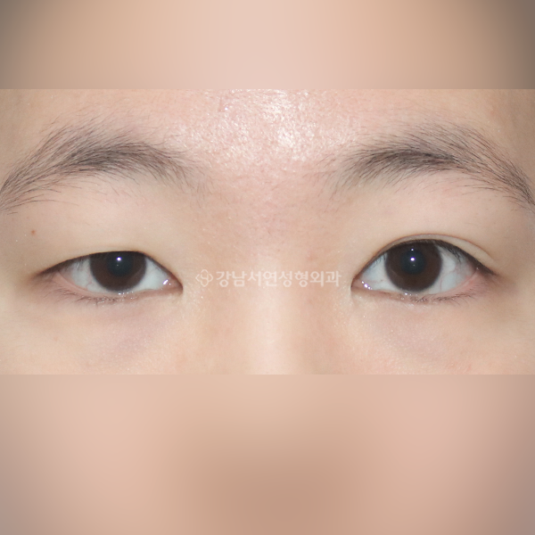 절개쌍꺼풀 재수술+짝눈교정 BEFORE