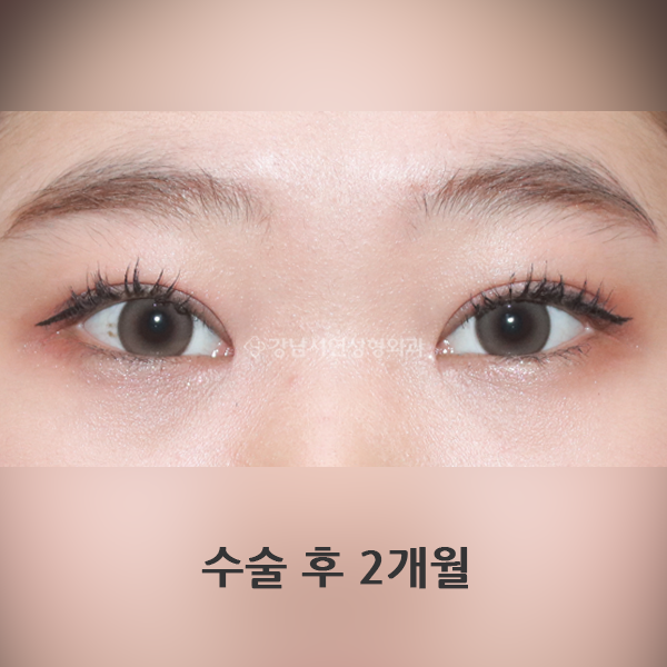 절개눈매교정+앞트임 AFTER