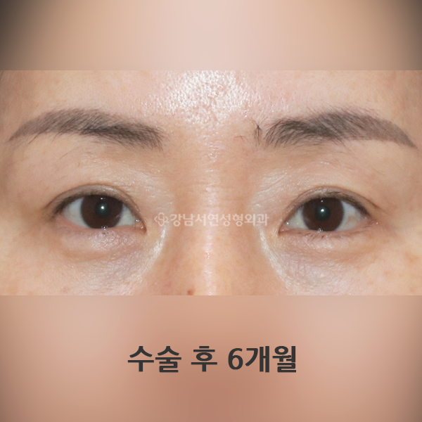 상안검+뒤밑트임 AFTER
