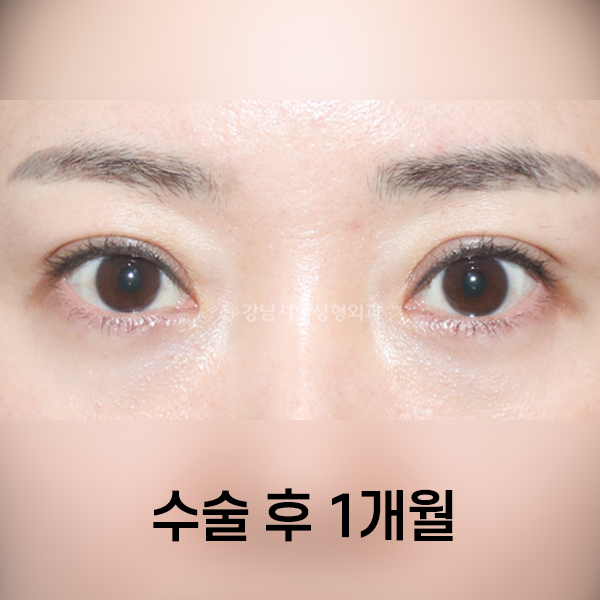 상안검 AFTER