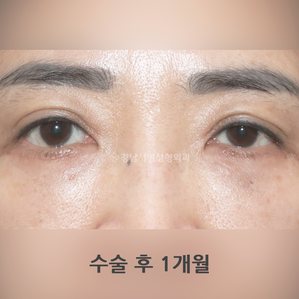 하안검수술 AFTER