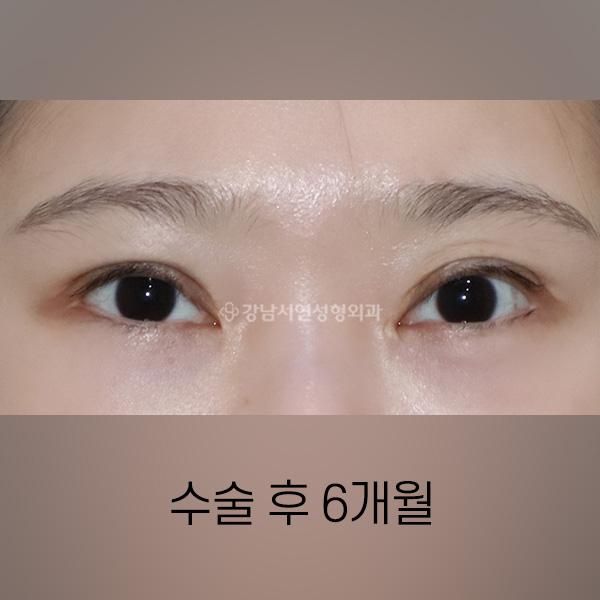 양쪽 퇴축수술 + 겹주름 개선 AFTER