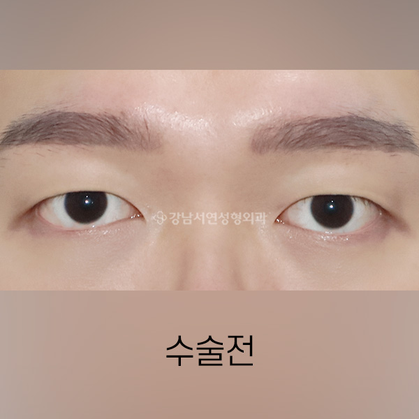 남자 무쌍(속쌍)수술 BEFORE