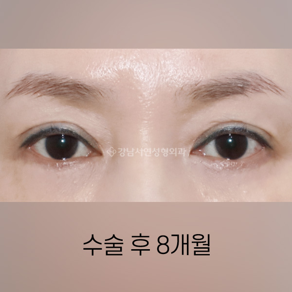 지방이식 후 겹주름이 발생한 쌍꺼풀을 이물질 제거 및 라인교정 AFTER
