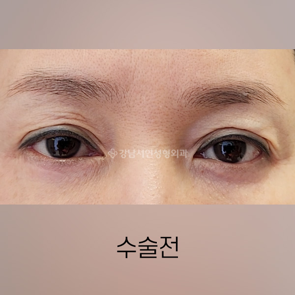 지방이식 후 겹주름이 발생한 쌍꺼풀을 이물질 제거 및 라인교정 BEFORE