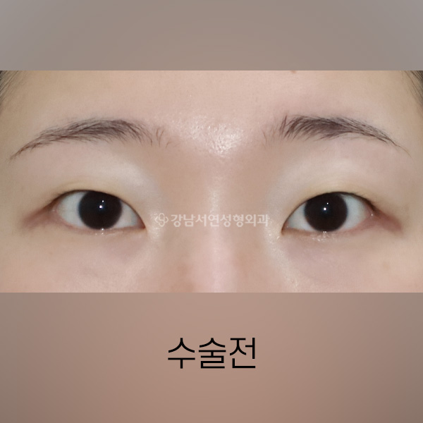 매몰쌍꺼풀 + 앞트임 BEFORE