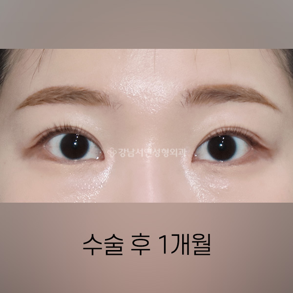 매몰쌍꺼풀 + 앞트임 AFTER