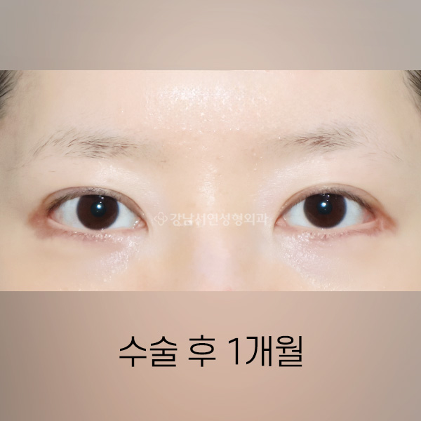뒤트임 복원 AFTER