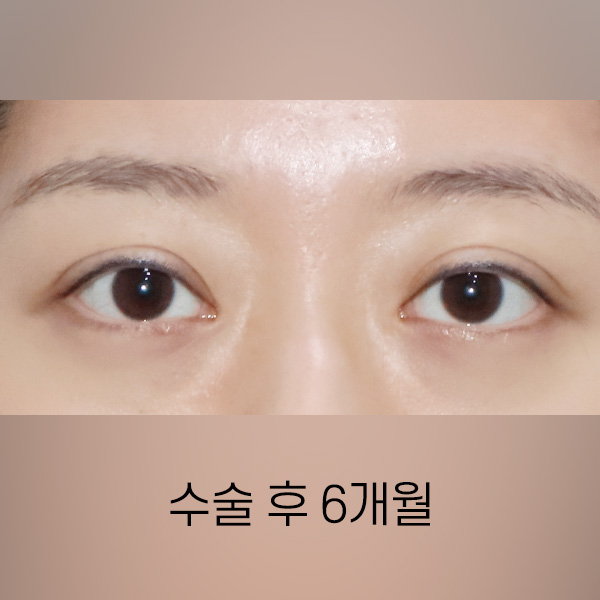 퇴축수술 AFTER