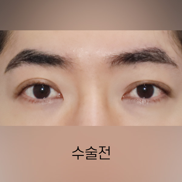 남자 쌍꺼풀 낮추기 BEFORE