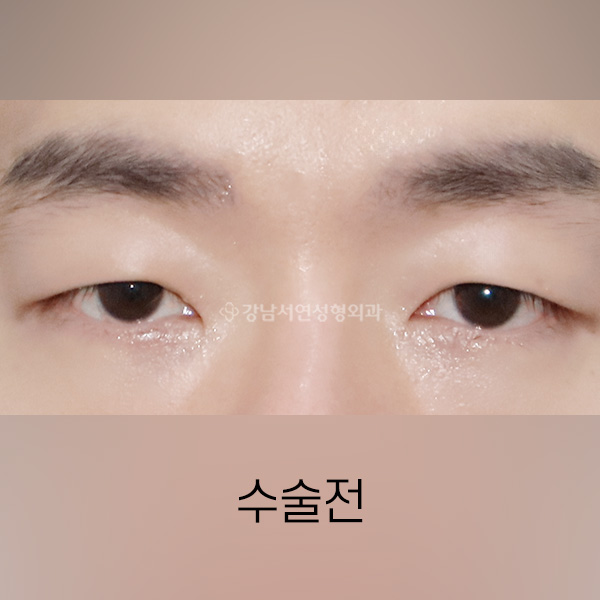 남자 절개쌍꺼풀 BEFORE