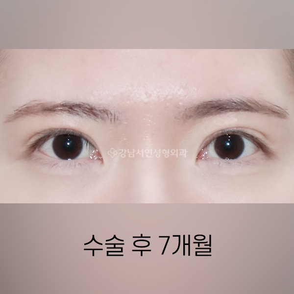 퇴축수술 AFTER