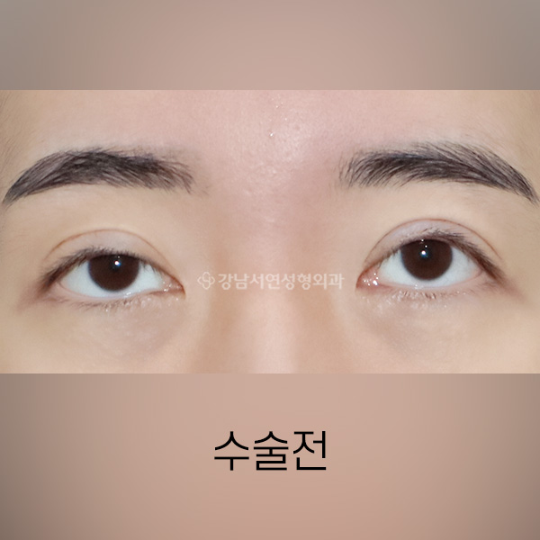 절개눈매교정 재수술 BEFORE