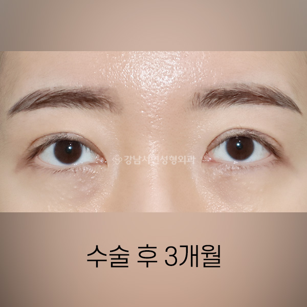 절개눈매교정 재수술 AFTER