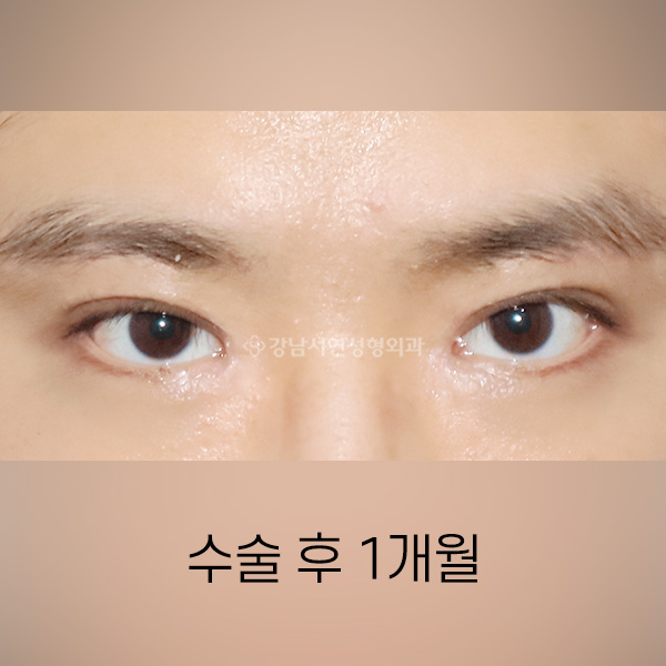 퇴축수술 AFTER