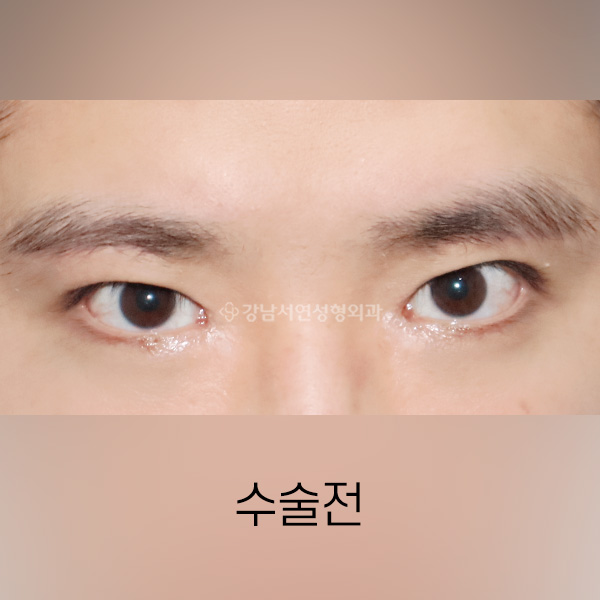 퇴축수술 BEFORE