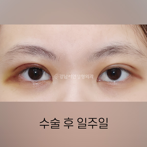 절개눈매교정 AFTER
