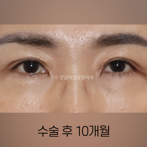 상안검 + 눈밑지방재배치 AFTER