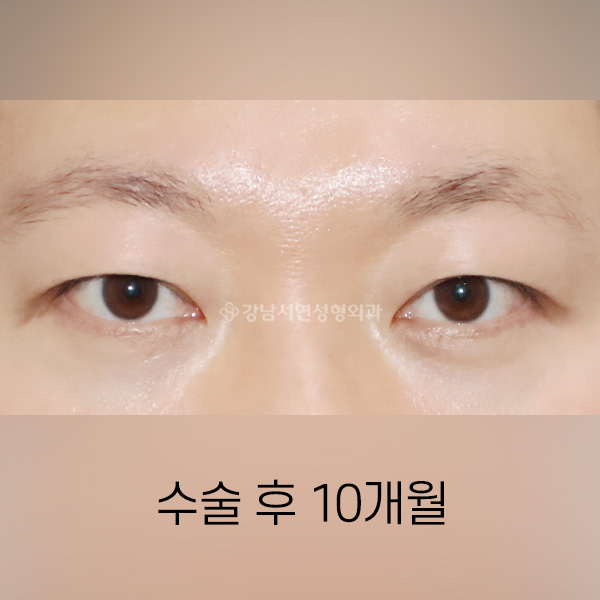 남자쌍꺼풀 낮추기 AFTER