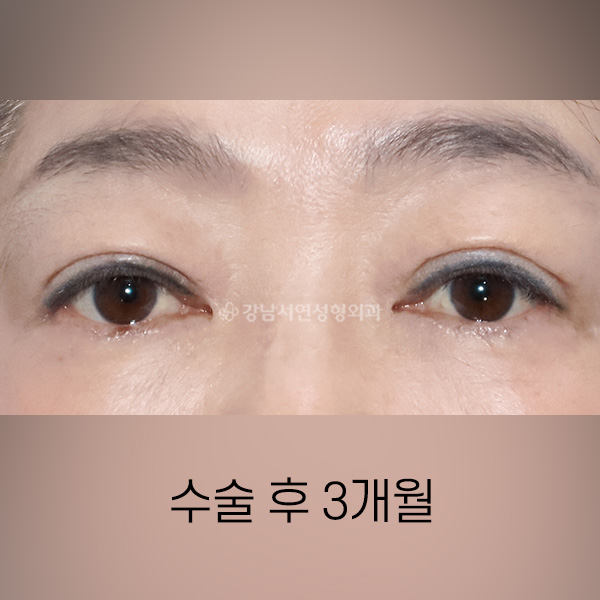 상안검 AFTER