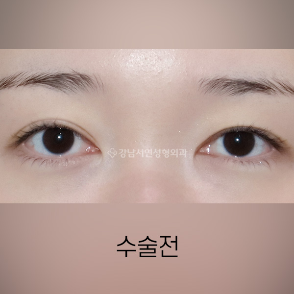 절개쌍꺼풀 재수술 BEFORE