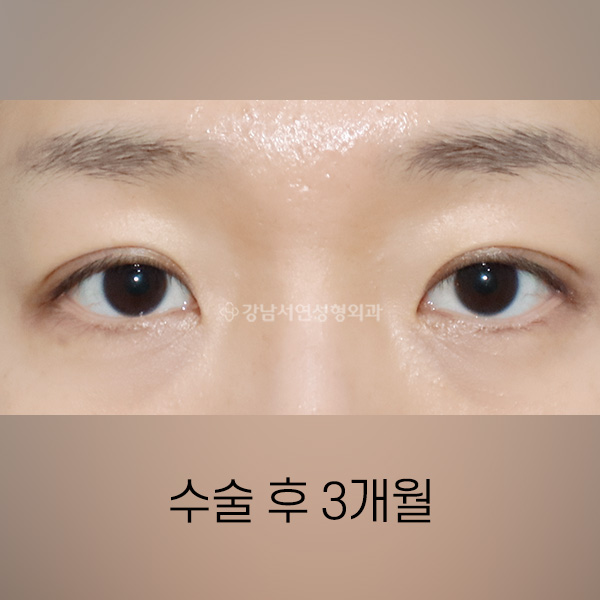 절개쌍꺼풀 AFTER