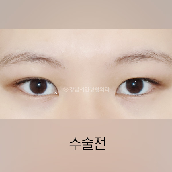 절개쌍꺼풀 + 앞트임 BEFORE