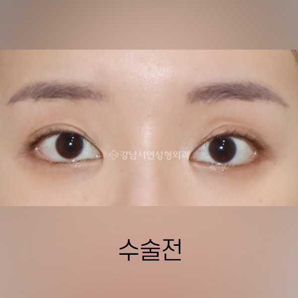 절개쌍꺼풀 재수술 BEFORE