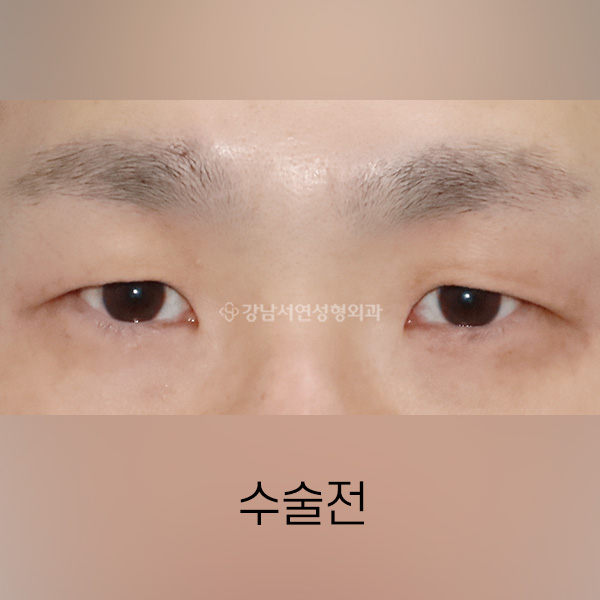 남자 무쌍속쌍꺼풀 수술 BEFORE