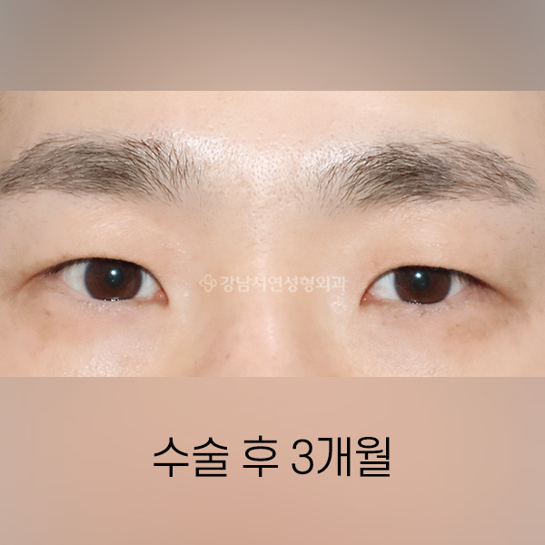 남자 무쌍속쌍꺼풀 수술 AFTER