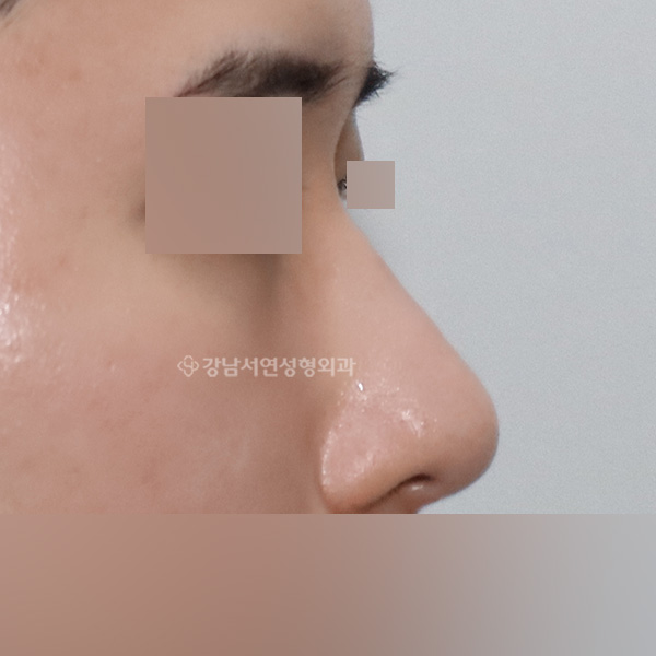 무보형물 코성형 AFTER