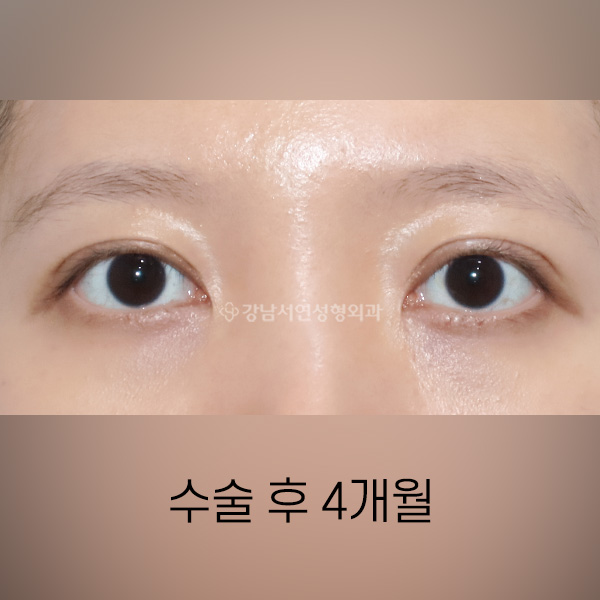 라인높이는 두줄따기 AFTER