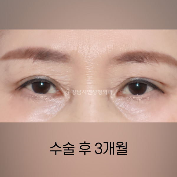상안검 AFTER