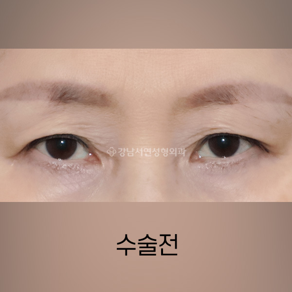 상안검 BEFORE