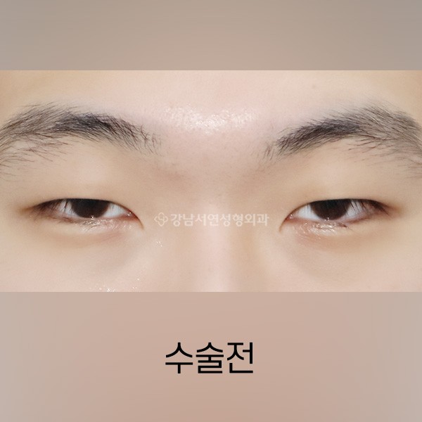 남자무쌍눈매교정 BEFORE