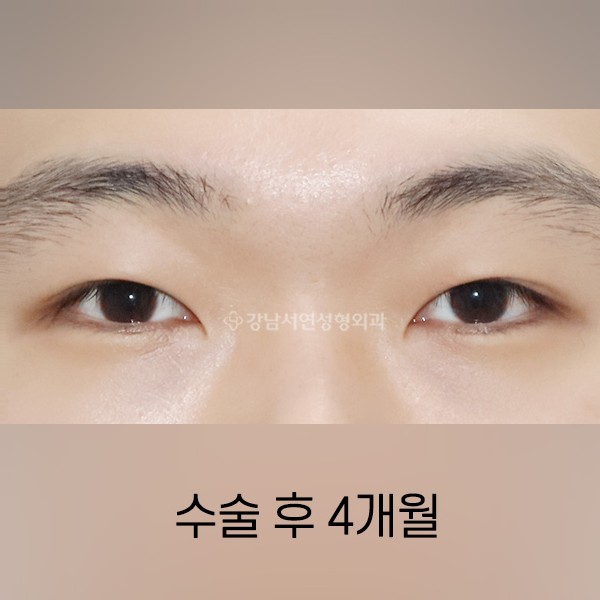 남자무쌍눈매교정 AFTER