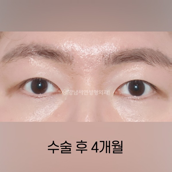 남자 쌍꺼풀 낮추기 AFTER