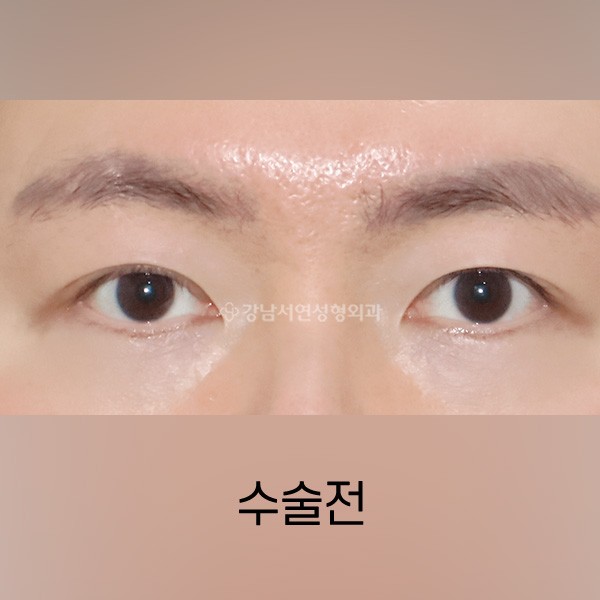 남자 쌍꺼풀 낮추기 BEFORE