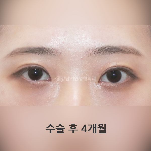 점막들림+짝눈교정+쌍꺼풀재수술 AFTER