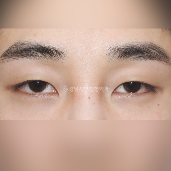 남자무쌍눈매교정 BEFORE
