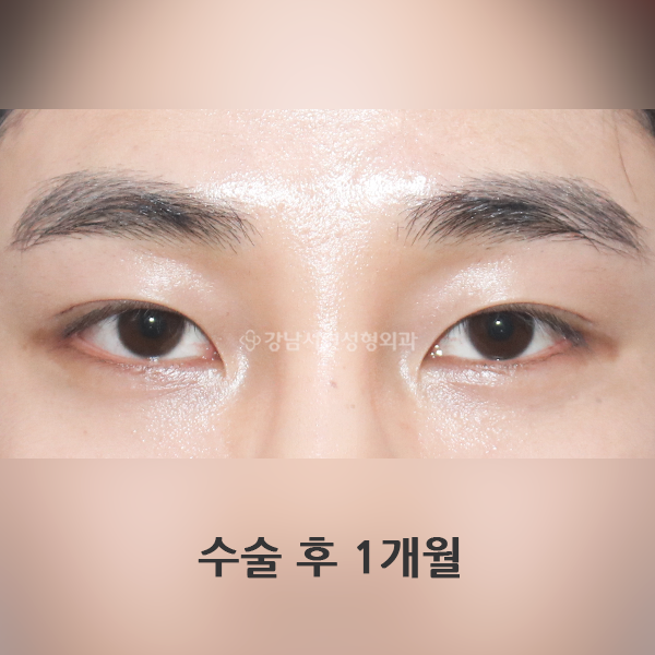 남자무쌍눈매교정 AFTER